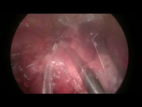 Uniportal VATS Enbloc Anatomic Segmentectomy S7+S4-5