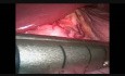 Laparoscopic Sleeve Gastrectomy with the Use of Gastric Positioning Device
