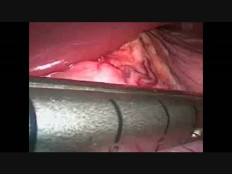 Laparoscopic Sleeve Gastrectomy with the Use of Gastric Positioning Device
