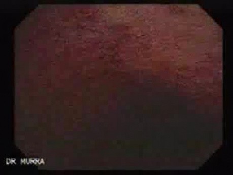 Colitis Ulcerosa - Pseudopolyps (19 of 22)