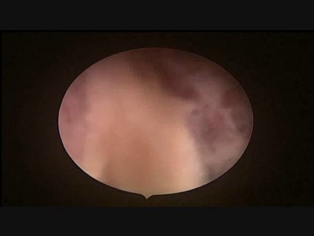 Scar Ectopic Pregnancy