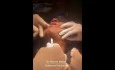 Submental Intubation for a Patient with Complex Maxillofacial Injuries