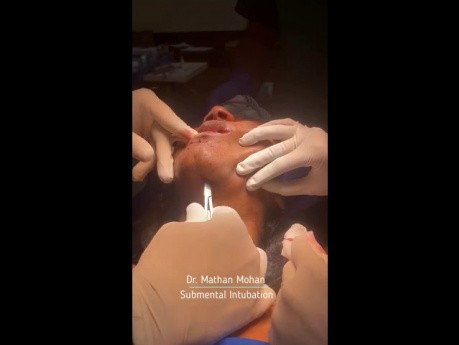 Submental Intubation for a Patient with Complex Maxillofacial Injuries