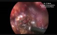 Laparoscopic Necrosectomy in Acute Necrotizing Pancreatitis