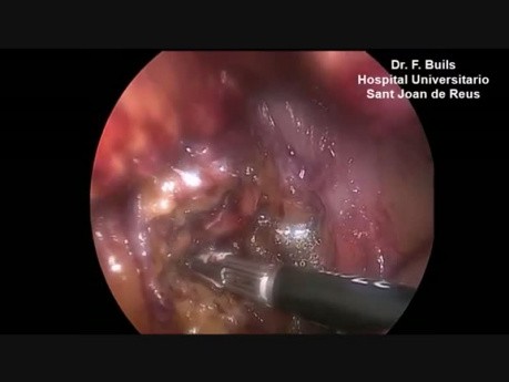 Laparoscopic Necrosectomy in Acute Necrotizing Pancreatitis