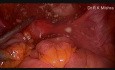 Laparoscopic Dermoid Cystectomy