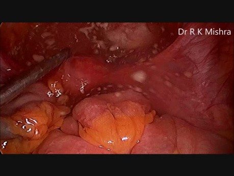 Laparoscopic Dermoid Cystectomy