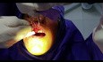 Crown Lenght Surgery