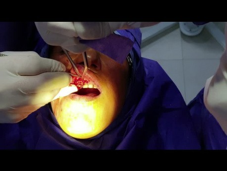 Crown Lenght Surgery
