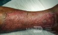 Atrophic Lower Leg Ulceration- Stage IV