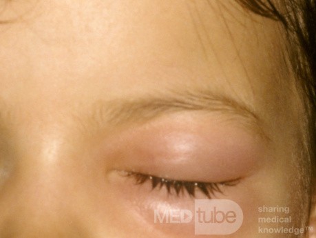 Orbital Cellulitis Secondary To Acute Pansinusitis 1