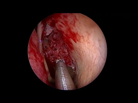 Complete Endoscopic Sinus Surgery - Systematic Front to Back Approach