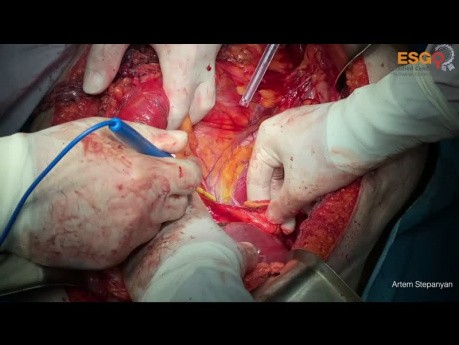Ovarian Cancer Cytoreductive Surgery. One Block Resection of Stage IIIC Ovarian Cancer.