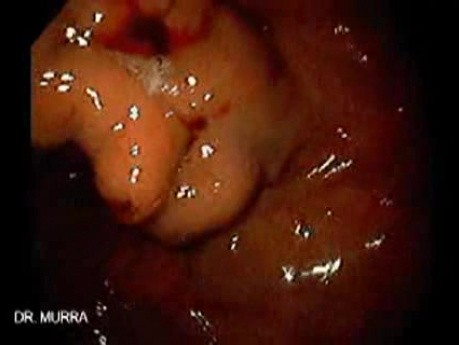 Gastric Varices (8 of 25)