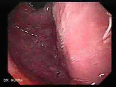 Gastric Cicatrization With Pylorus Stenosis (12 of 23)