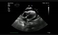 Heart Tamponade