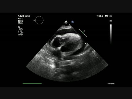 Heart Tamponade