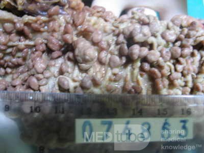 Synchronous Cancers, Familial Adenomatous Polyposis (32 of 36)