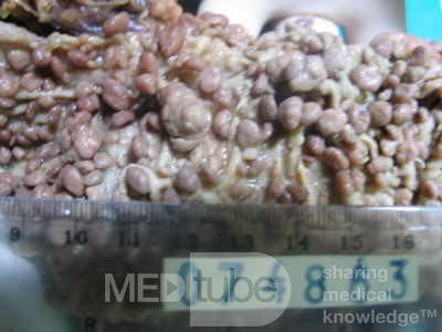 Synchronous Cancers, Familial Adenomatous Polyposis (32 of 36)