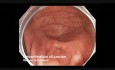 Colonoscopy Channel - Hidden Polyp During Cecal Examination