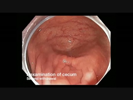 Colonoscopy Channel - Hidden Polyp During Cecal Examination