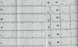 Hypertrophic Cardiomyopathy the ECG, Echocardiography and Treatment