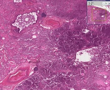 Bronchopneumonia With Micro-Abscesses