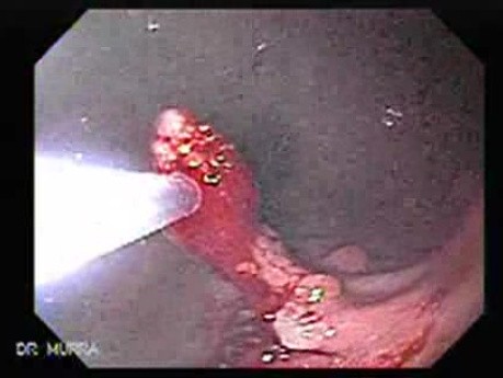 Gastric Polyposis - Endoscopy (7 of 11)