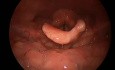 Epiglottic Defect - Left Side