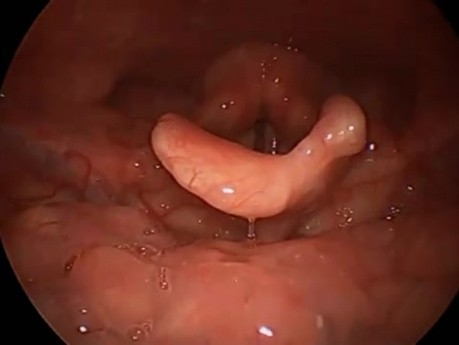Epiglottic Defect - Left Side