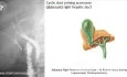 Cystic Duct Joining Accessory Aberrant RHD