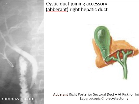 Cystic Duct Joining Accessory Aberrant RHD