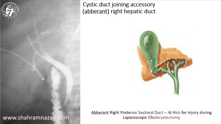 Cystic Duct Joining Accessory Aberrant RHD