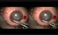 Haemorrhagic Glaucoma, Reverse Cyclodialysis