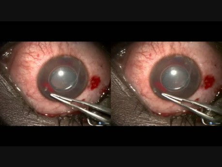 Haemorrhagic Glaucoma, Reverse Cyclodialysis