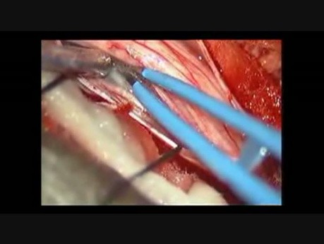 Spinal Cord Tumor - Intra Dural Neurofibroma  - Microsurgical Excision