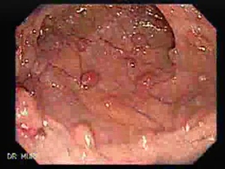 Familial Adenomatous Polyposis (6 of 36)
