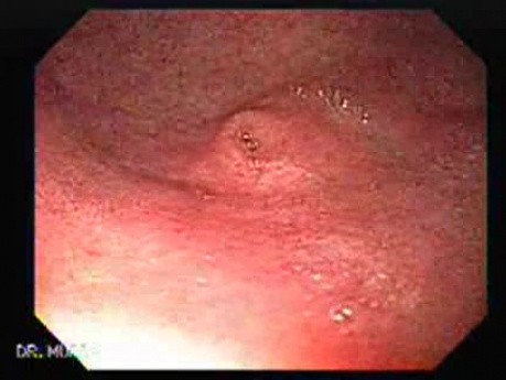 Heterotropic Pancreas (1 of 6)