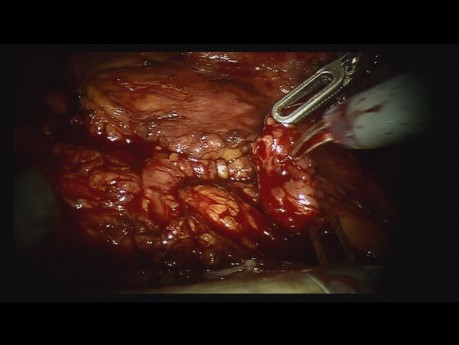 Radical Nephrectomy