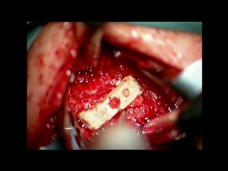 Revision Operation on the Cervical Spine