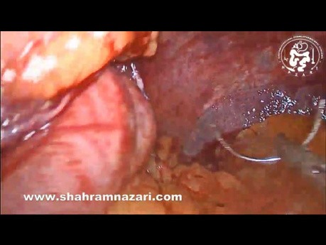 Giant Liver Hemangioma as an Incidentaloma During Sleeve Gastrectomy