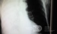 Chest X-ray PA View 