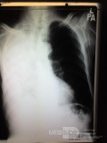Chest X-ray PA View 