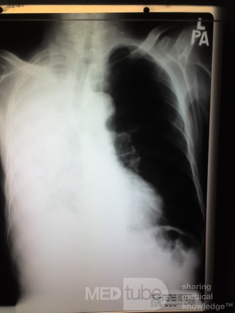Chest X-ray PA View 