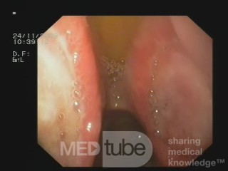 Twin Kissing Bulbar Ulcers