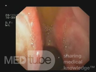 Twin Kissing Bulbar Ulcers