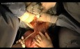 Surgery of Giant Leiomyosarcoma of the Uterus