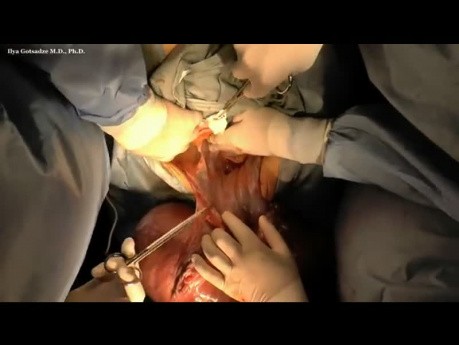 Surgery of Giant Leiomyosarcoma of the Uterus
