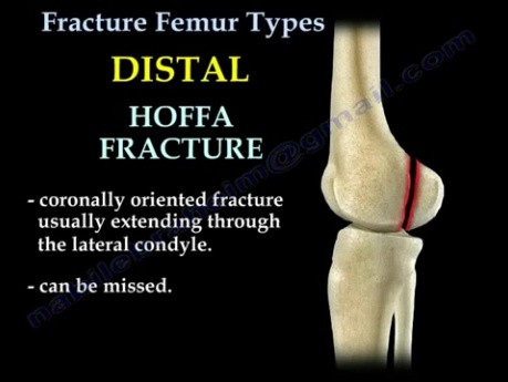 Fracture Femur Types 