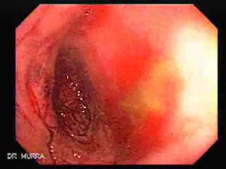 Consecutive colonoscopy with dilation was carried out (10 of 15)